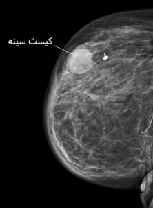 ماموگرافی سینه 
