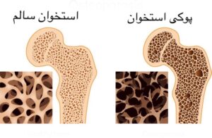 تفاوت پوکی استخوان و استخوان سالم