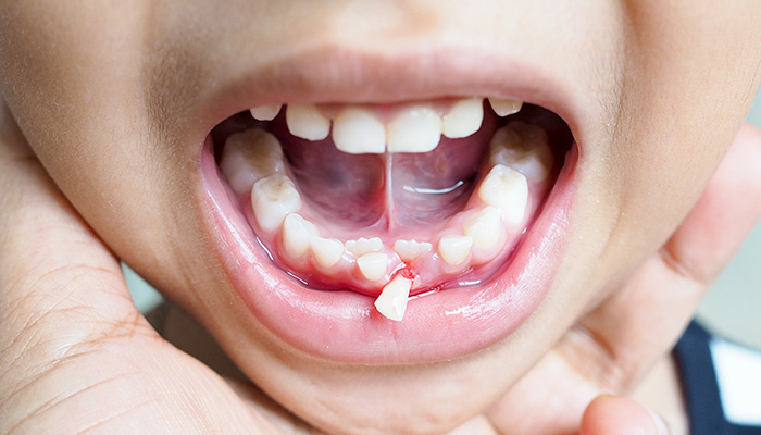 کشیدگی دندان برای درمان یبوست